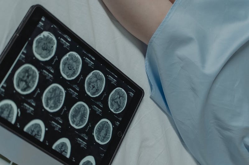 Adagrasib y metástasis cerebrales: ¿Funciona, es mejor que sotorasib y cómo conseguirlo?