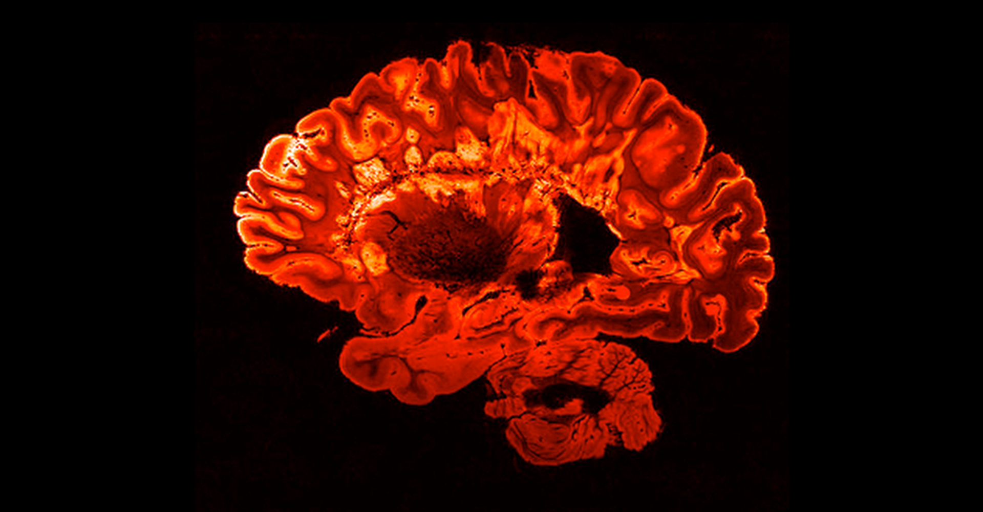 resonancia magnética roja del cerebro